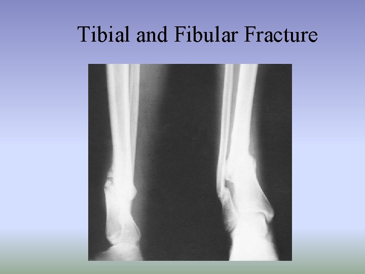 Tibial and Fibular Fracture 