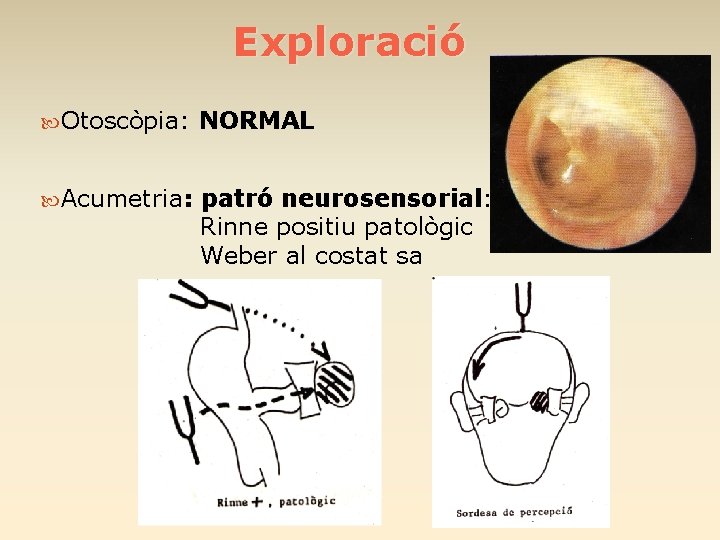 Exploració Otoscòpia: NORMAL Acumetria: patró neurosensorial: Rinne positiu patològic Weber al costat sa 