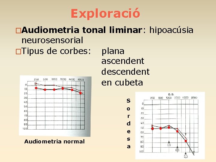 Exploració �Audiometria tonal liminar: hipoacúsia neurosensorial �Tipus de corbes: plana ascendent descendent en cubeta