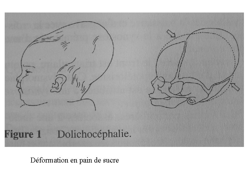 Déformation en pain de sucre 