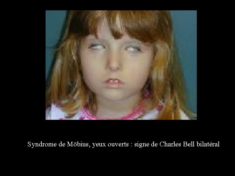 Syndrome de Möbius, yeux ouverts : signe de Charles Bell bilatéral 