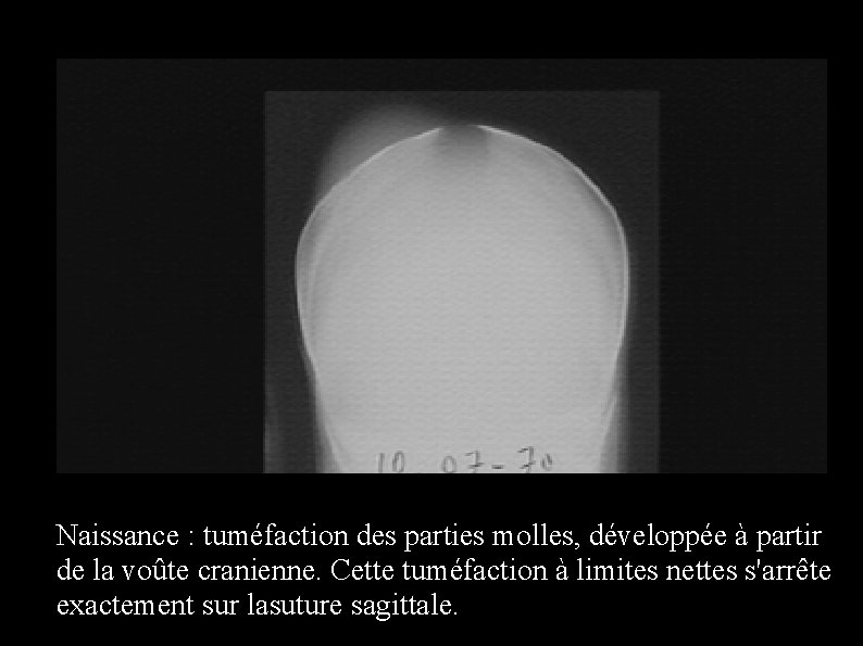Naissance : tuméfaction des parties molles, développée à partir de la voûte cranienne. Cette