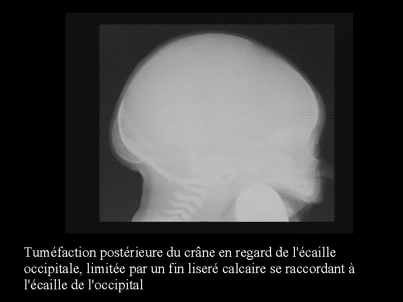 Tuméfaction postérieure du crâne en regard de l'écaille occipitale, limitée par un fin liseré