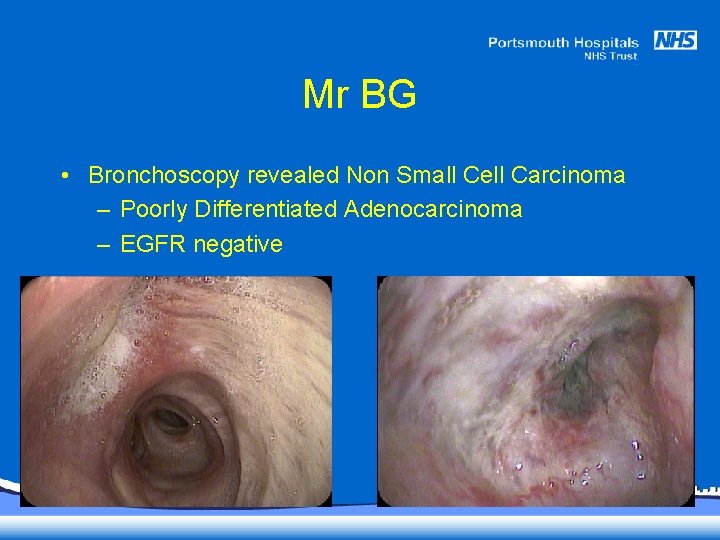 Mr BG • Bronchoscopy revealed Non Small Cell Carcinoma – Poorly Differentiated Adenocarcinoma –