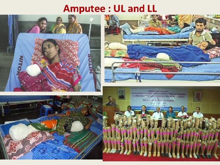 Amputee : UL and LL 
