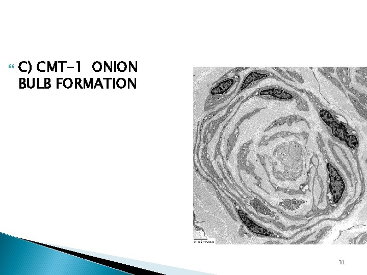  C) CMT-1 ONION BULB FORMATION 31 