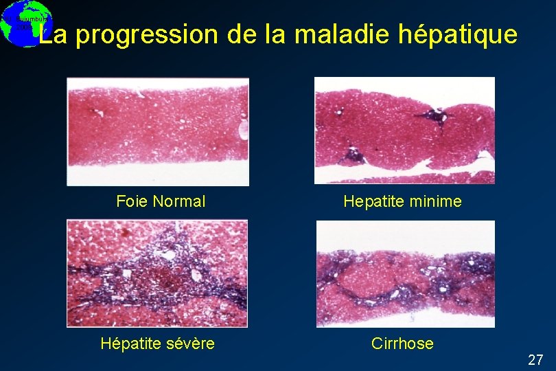 DIU Bujumbura 2008 La progression de la maladie hépatique Foie Normal Hepatite minime Hépatite