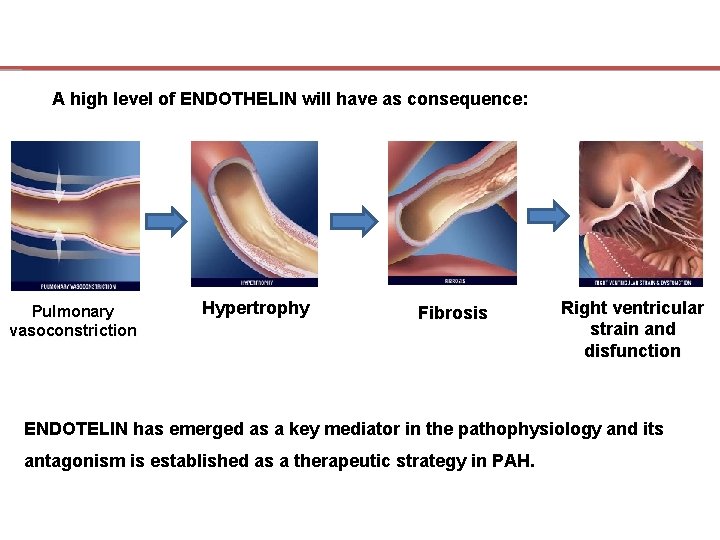 A high level of ENDOTHELIN will have as consequence: Pulmonary vasoconstriction Hypertrophy Fibrosis Right