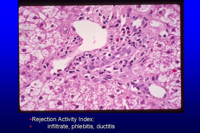  • Rejection Activity Index: • infiltrate, phlebitis, ductitis 