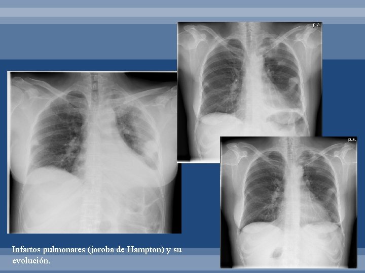 Infartos pulmonares (joroba de Hampton) y su evolución. 