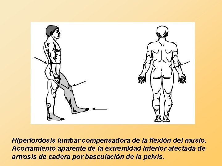 Hiperlordosis lumbar compensadora de la flexión del muslo. Acortamiento aparente de la extremidad inferior