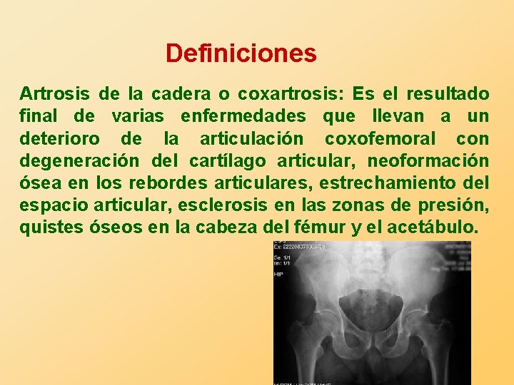 Definiciones Artrosis de la cadera o coxartrosis: Es el resultado final de varias enfermedades