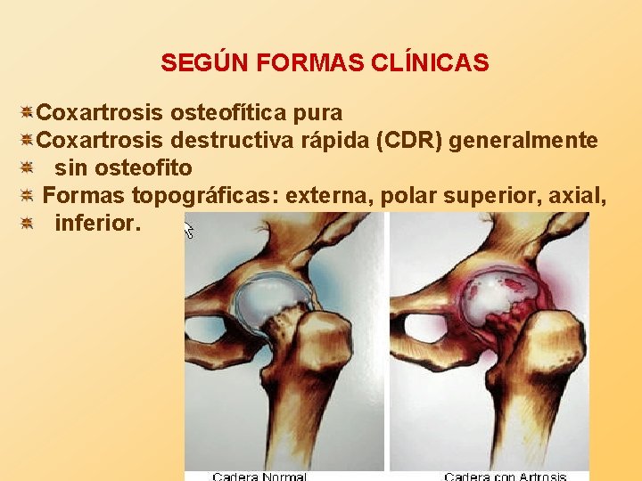 SEGÚN FORMAS CLÍNICAS Coxartrosis osteofítica pura Coxartrosis destructiva rápida (CDR) generalmente sin osteofito Formas