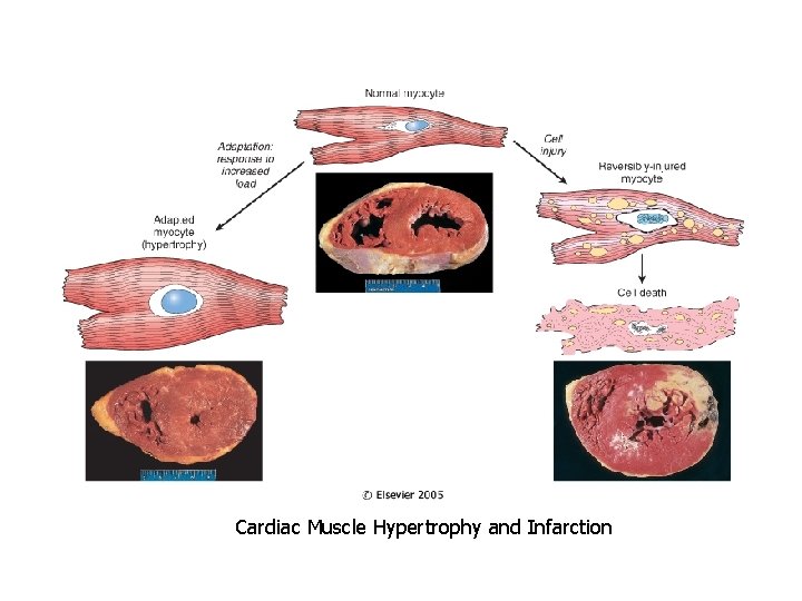 Cardiac Muscle Hypertrophy and Infarction 