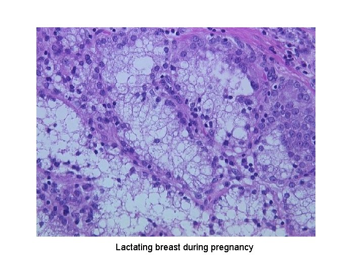 Lactating breast during pregnancy 