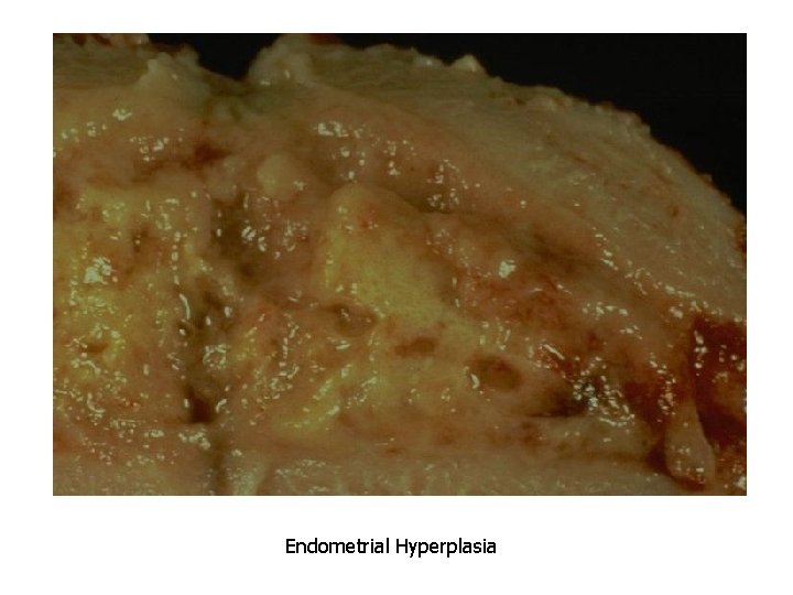 Endometrial Hyperplasia 