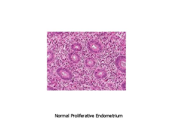 Normal Proliferative Endometrium 