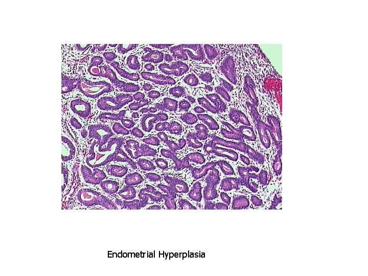 Endometrial Hyperplasia 