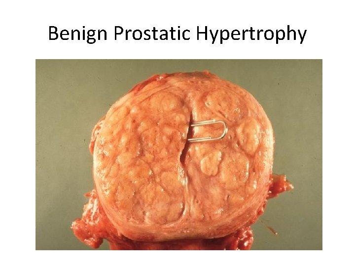 Benign Prostatic Hypertrophy 