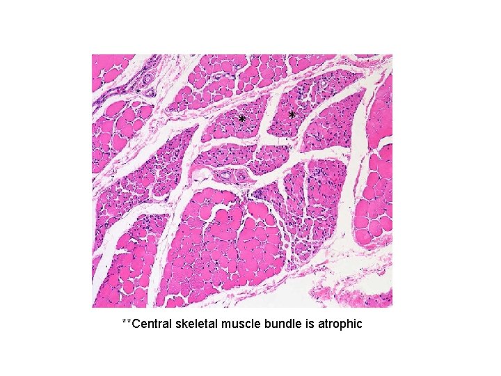 * * **Central skeletal muscle bundle is atrophic 