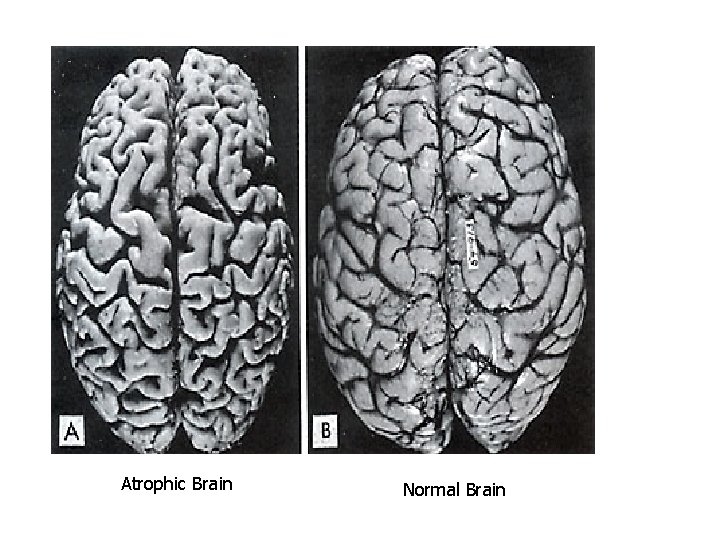 Atrophic Brain Normal Brain 