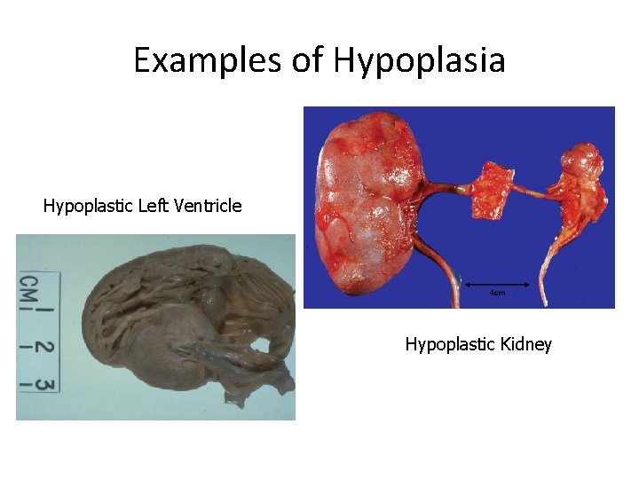 Examples of Hypoplasia Hypoplastic Left Ventricle Hypoplastic Kidney 