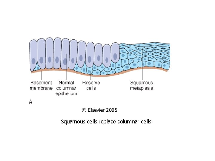 Squamous cells replace columnar cells 