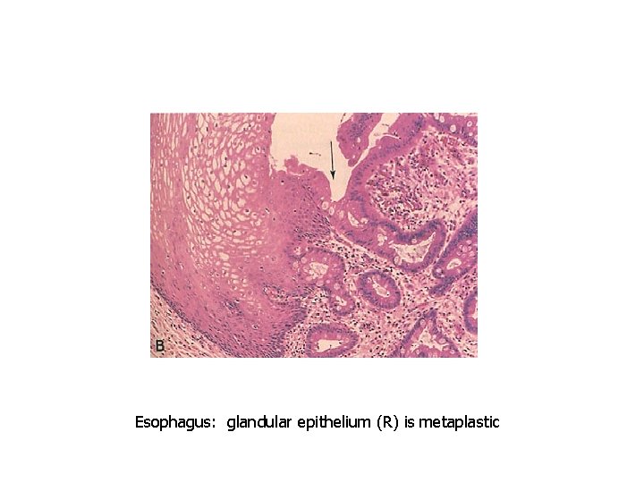 Esophagus: glandular epithelium (R) is metaplastic 