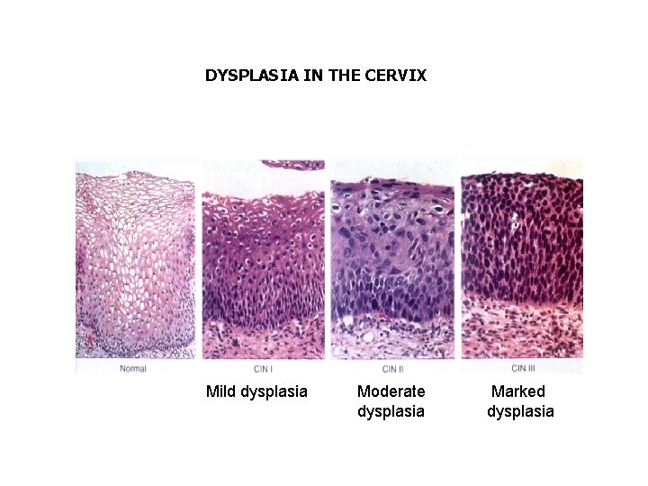 DYSPLASIA IN THE CERVIX Mild dysplasia Moderate dysplasia Marked dysplasia 