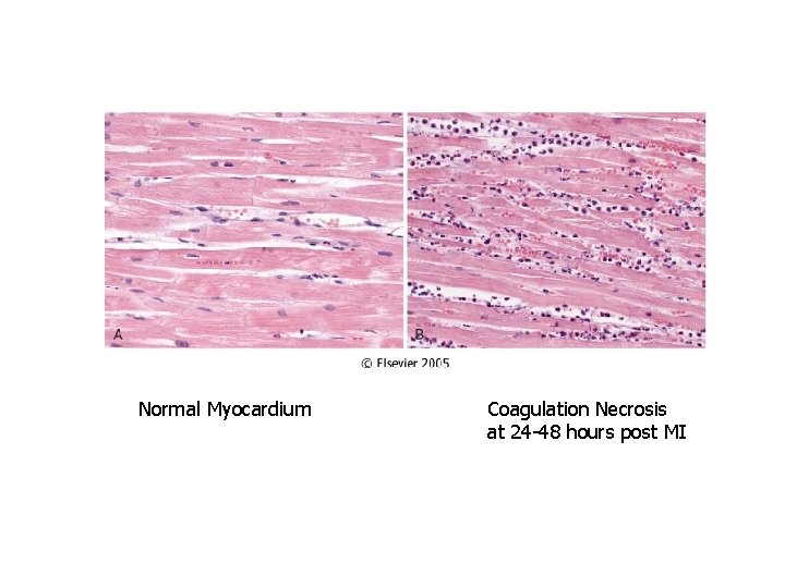 Normal Myocardium Coagulation Necrosis at 24 -48 hours post MI 
