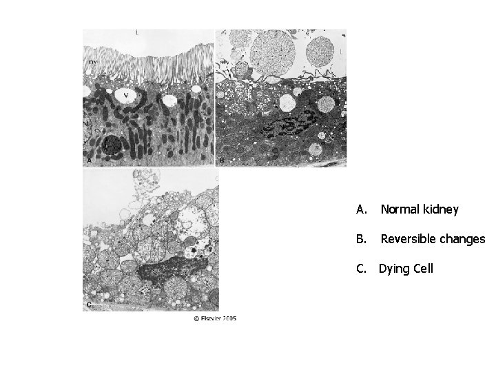 A. Normal kidney B. Reversible changes C. Dying Cell 