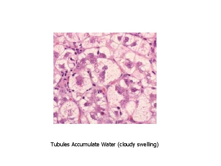 Tubules Accumulate Water (cloudy swelling) 