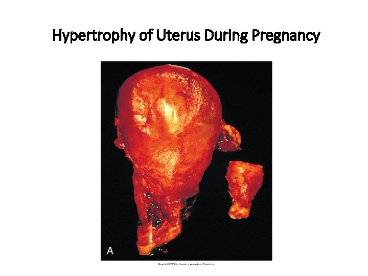Hypertrophy of Uterus During Pregnancy 