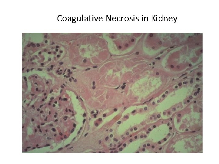 Coagulative Necrosis in Kidney 