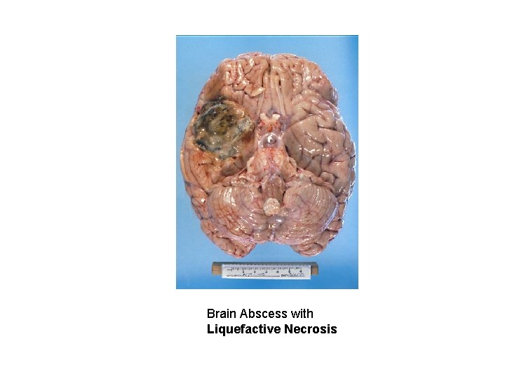 Brain Abscess with Liquefactive Necrosis 
