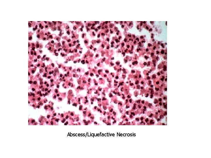 Abscess/Liquefactive Necrosis 