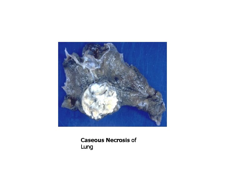 Caseous Necrosis of Lung 