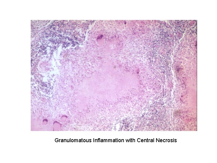 Granulomatous Inflammation with Central Necrosis 