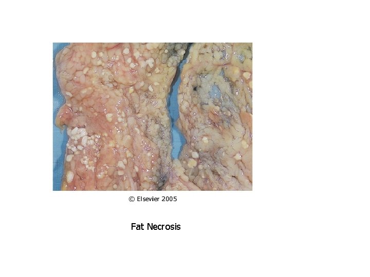 Fat Necrosis 