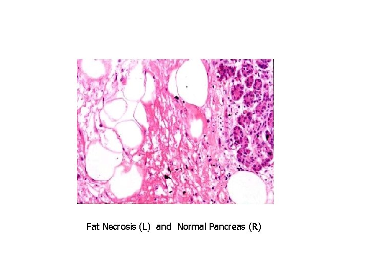 Fat Necrosis (L) and Normal Pancreas (R) 