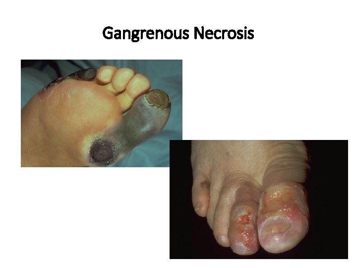 Gangrenous Necrosis 
