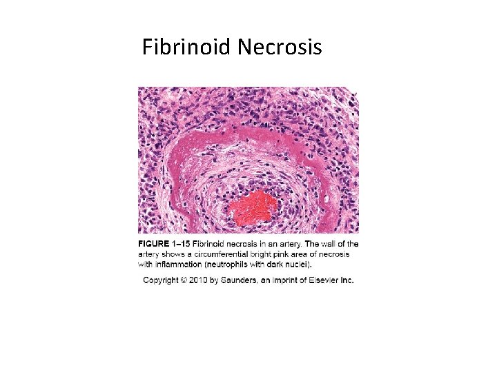 Fibrinoid Necrosis 