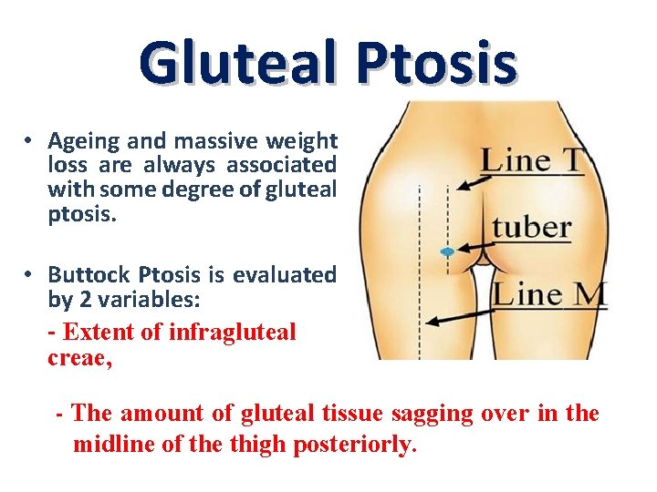 Gluteal Ptosis • Ageing and massive weight loss are always associated with some degree