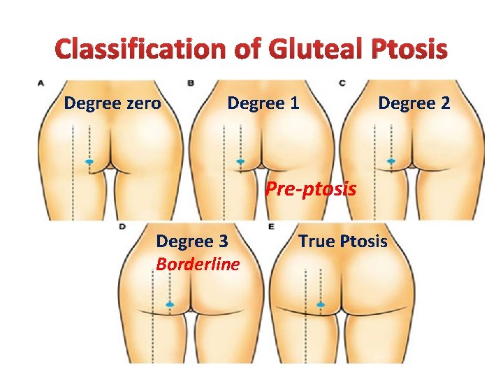 Classification of Gluteal Ptosis Degree zero Degree 1 Degree 2 Pre-ptosis Degree 3 Borderline