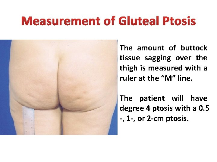 Measurement of Gluteal Ptosis The amount of buttock tissue sagging over the thigh is