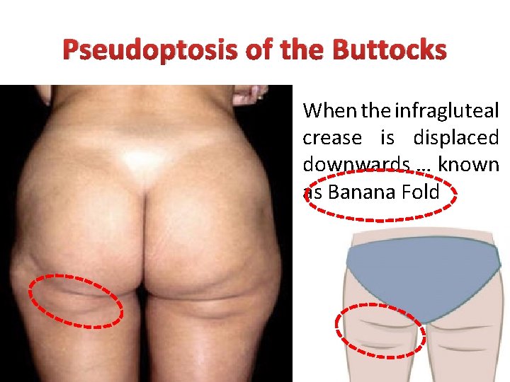 Pseudoptosis of the Buttocks When the infragluteal crease is displaced downwards … known as