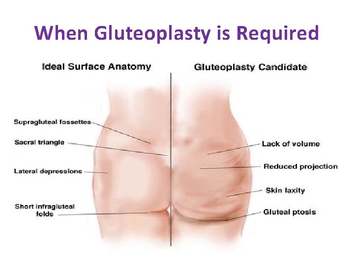 When Gluteoplasty is Required 
