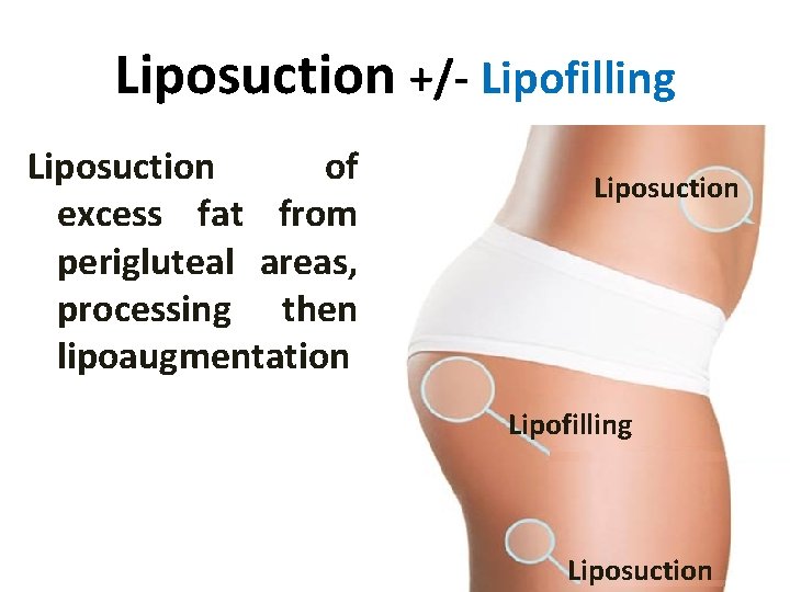 Liposuction +/- Lipofilling Liposuction of excess fat from perigluteal areas, processing then lipoaugmentation Liposuction