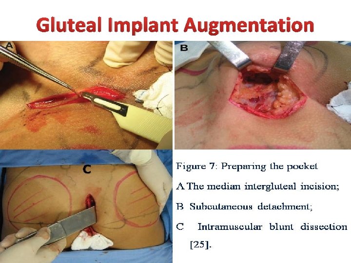 Gluteal Implant Augmentation 