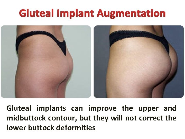 Gluteal Implant Augmentation Gluteal implants can improve the upper and midbuttock contour, but they